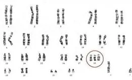 Human karyotype with trisomy 18