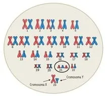 Human karyotype with trisomy 21