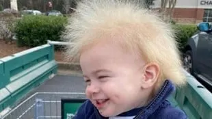 Síndrome del pelo indomable