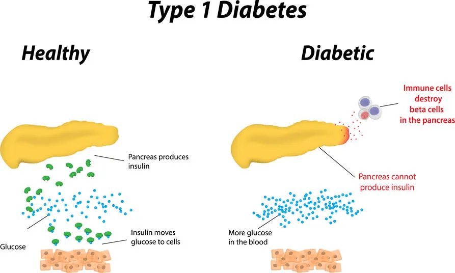 Type 1 diabetes - autoimmune disease
