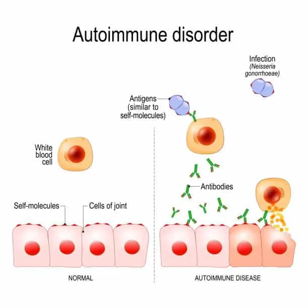 Lupus at the molecular level