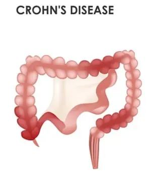 Morbus Crohn