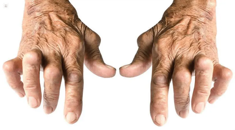 Artritis reumatoide