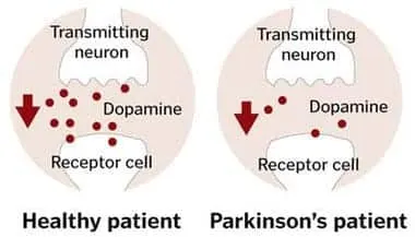 Parkinson's disease and dopamine