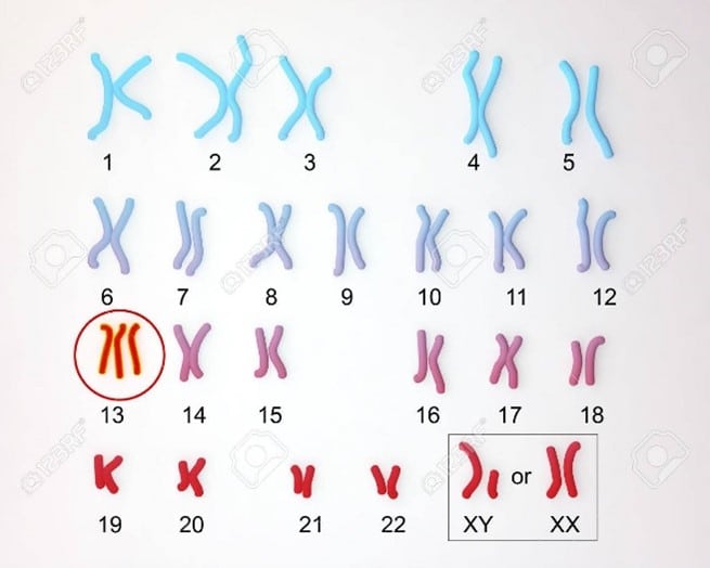 Menschlicher Karyotyp mit Trisomie auf Chromosom 13