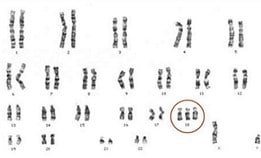 Menschlicher Karyotyp mit Trisomie auf Chromosom 18
