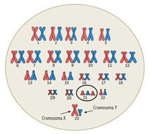 Menschlicher Karyotyp mit Trisomie auf Chromosom 21