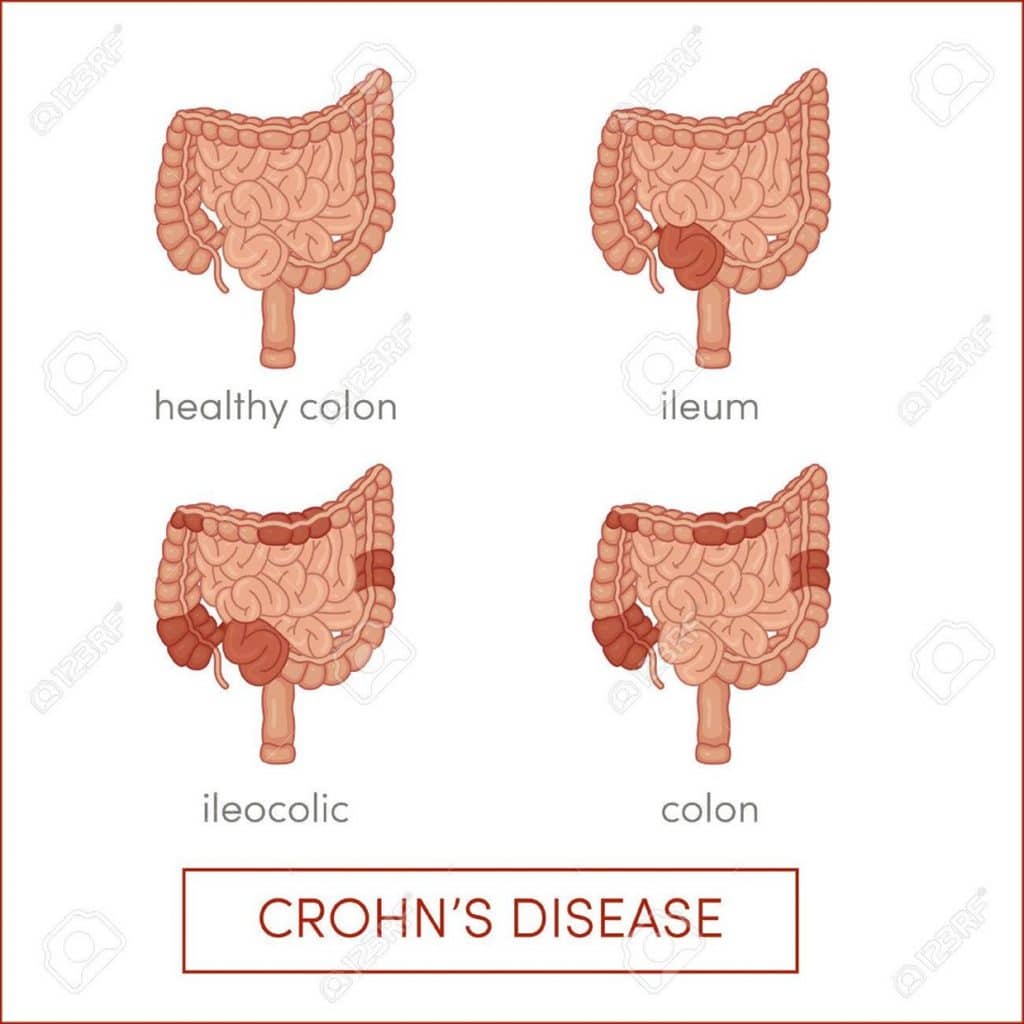 Arten von Morbus Crohn