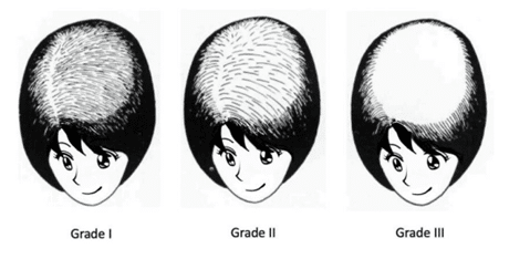 Degrees of female baldness