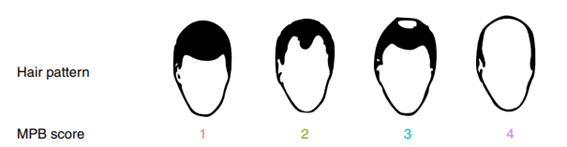 Common male baldness patterns
